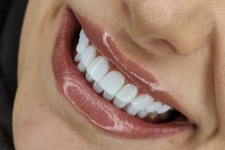 زیبایی و سلامت دندان با پایین‌ترین قیمت در قائمشهر با پرداخت شرایطی 